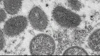 Monkeypox vaccines, testing becoming more available