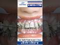 Abnormal teeth position and correction with metal braces  treatment Basal Implants in Jalandhar
