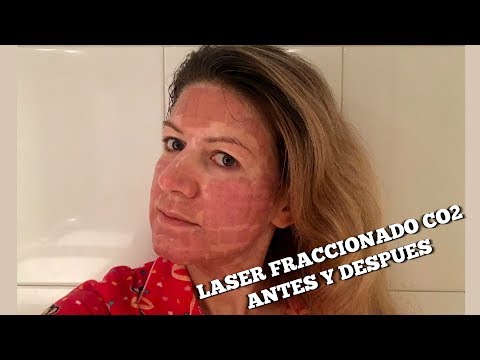 Laser fraccionado CO acne, manchas y rejuvenecimiento -  experiencia