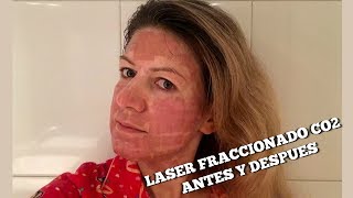 Láser? después del ¿Puedes con volar tratamiento