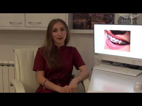 Брекеты и типы брекет-систем