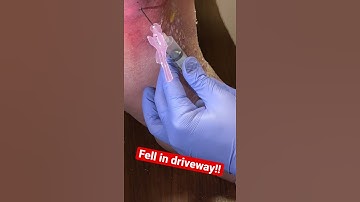 DRAINING A LEG HEMATOMA! #shorts #hematoma