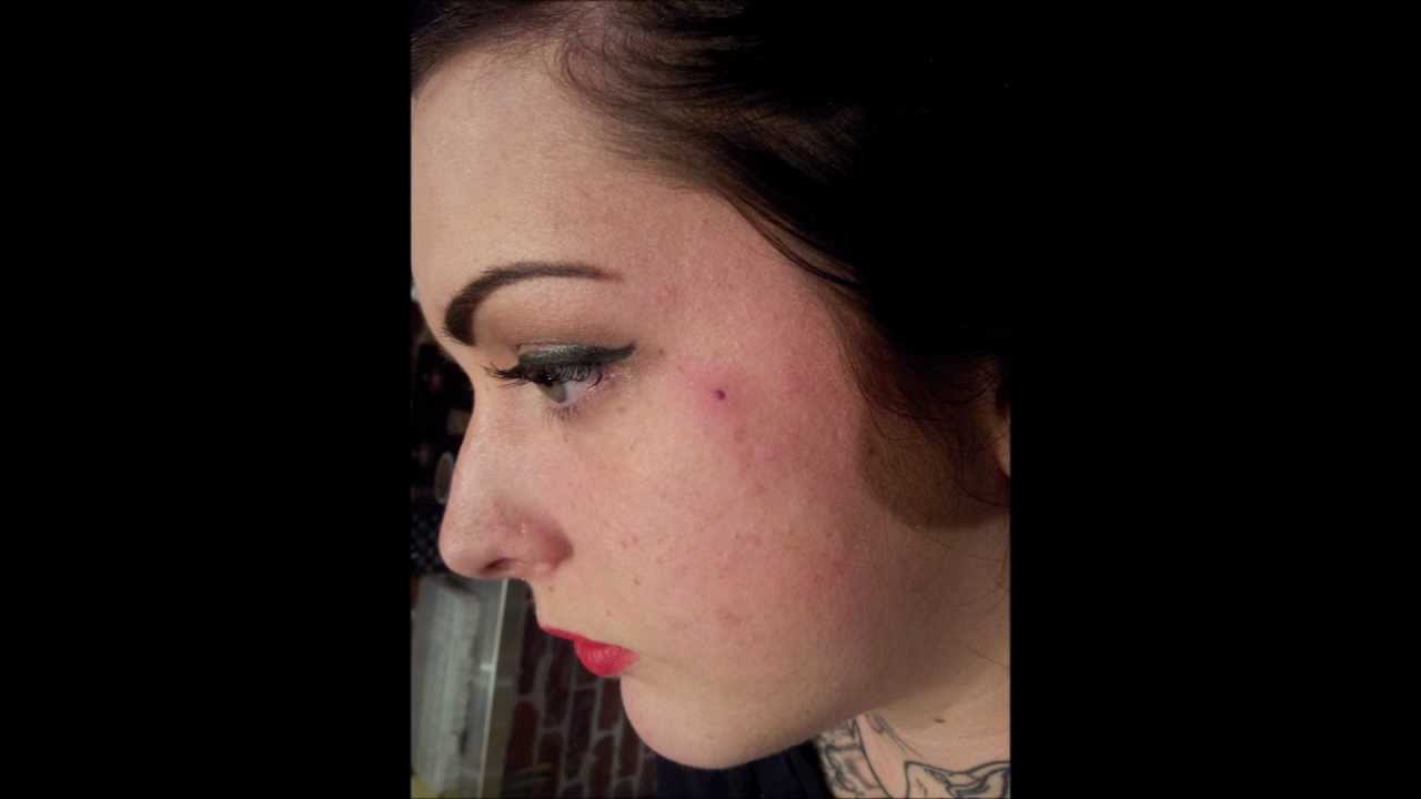 dermal piercing face scar