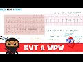 Rate and Rhythm | Supraventricular Tachycardia (SVT) and Wolff-Parkinson-White (WPW) Syndrome