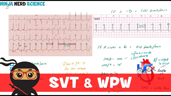 Rate and Rhythm | Supraventricular Tachycardia (SVT) and Wolff-Parkinson-White (WPW) Syndrome