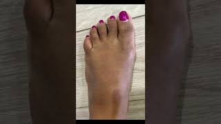 Foot Slimming Surgery Before & After