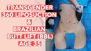 Hourglass Transformation: Transgender 360 Liposuction And Brazilian Butt Lift (BBL)