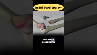 Radial Hand Implant Surgery #shorts