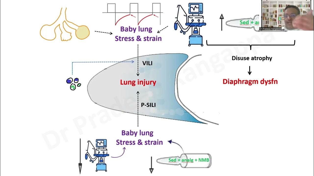 Lung & Diaphragm protective ventilation Overview_Dr Pradeep Rangappa
