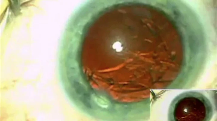 Zero CDE POP AND CHOP- Fredric Gross M.D.