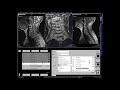 C spine MRI positioning +contrast enchanc