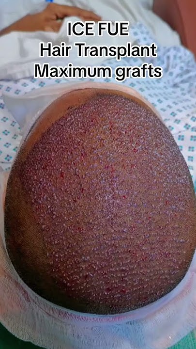 ice-fue-hair-transplant-full-head-coverage-youtube