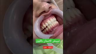 تبييض الاسنان بالليزر||teeth whitening||laser teeth whitening before and after||bleaching||whiteteet