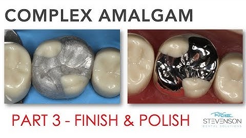 Complex Amalgam - Finishing & Polishing | Part 3