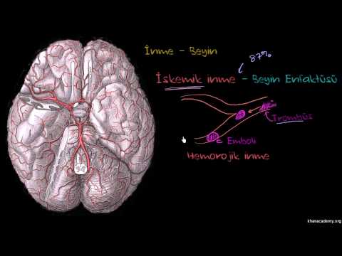 İnme (Sağlık: Çeşitli Konular)