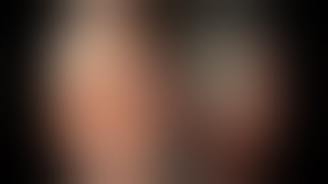 Colonoscopy: EMR of Ascending Colon SSA - prior incomplete resection