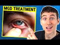 MGD (Dry Eye) Treatment Guide - How to Treat Meibomian Gland Dysfunction