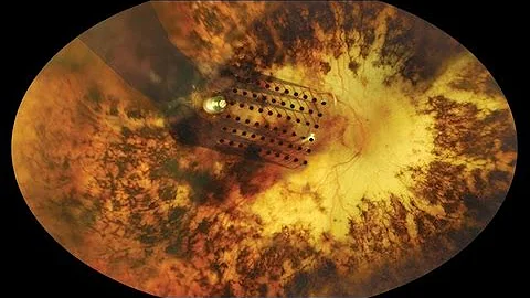 Have Scientists Created a Bionic Eye?
