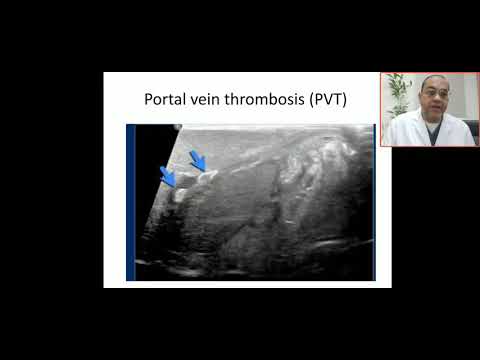Case 37 UVC in portal vein, portal vein thrombosis PVT