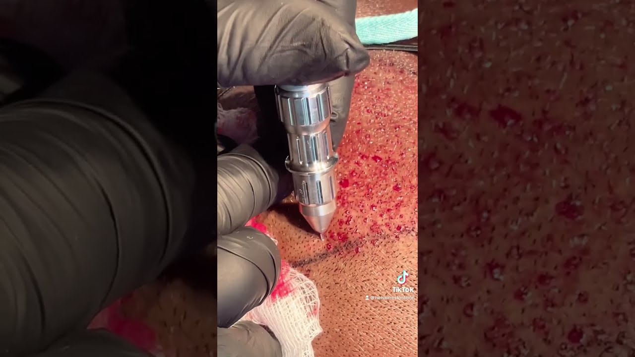 FUE Hair Transplant 