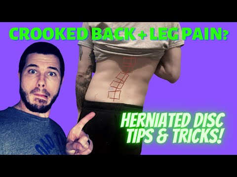 Crooked Back: Herniated Disc + Sciatica Treatment Tips & Tricks (Live Case Study)