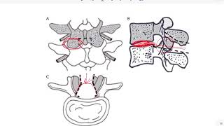 Tubercular Spine series - 7 ( Surgical approach)