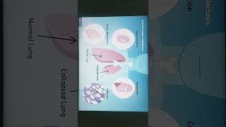 atelectasis pathophysiology  management  bscnursing trending viral easywaytomake nursing