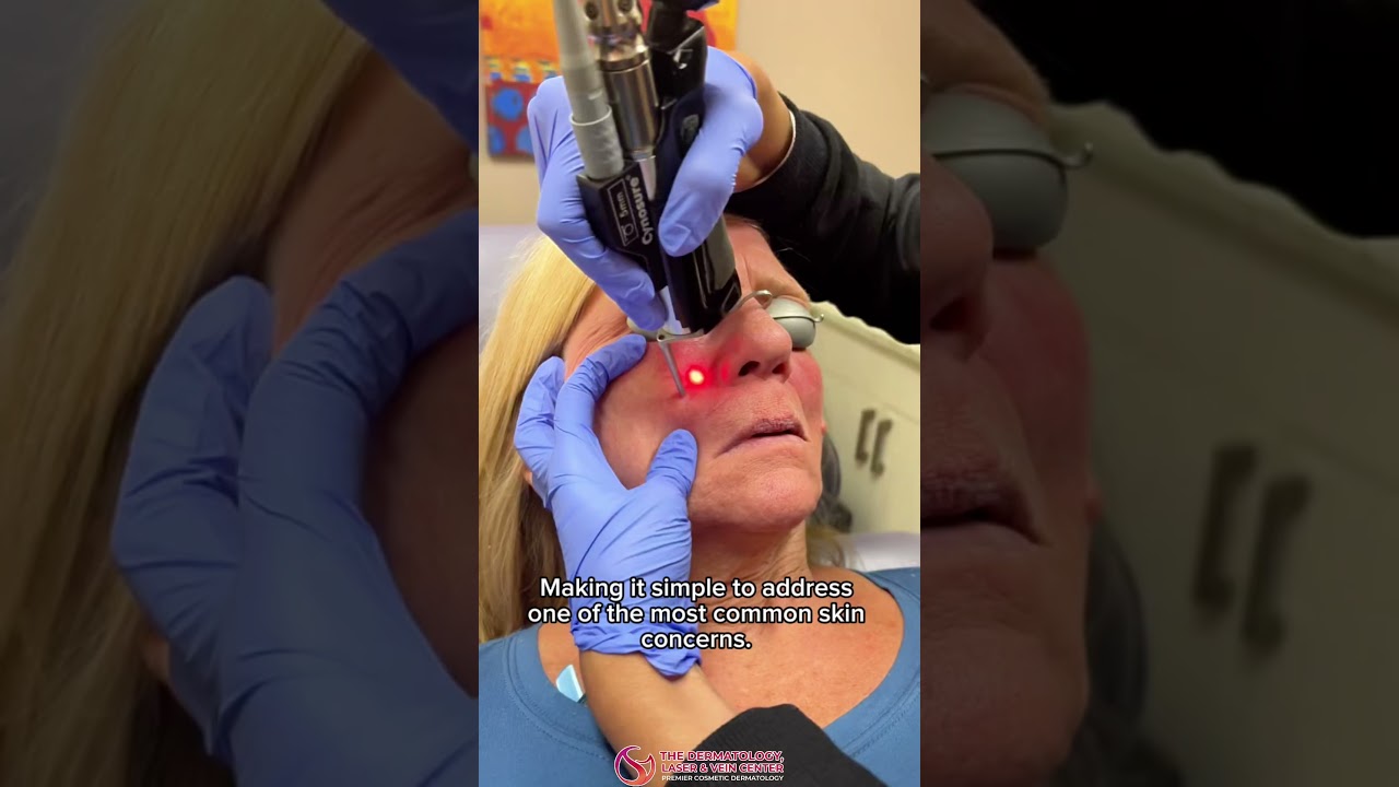 Dr. Gupta Removes Facial Veins Instantly | YAG Laser Treatment at DLVC