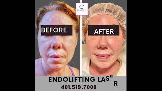 #Endolifting#eyererejuvenation#skincare #endolaser