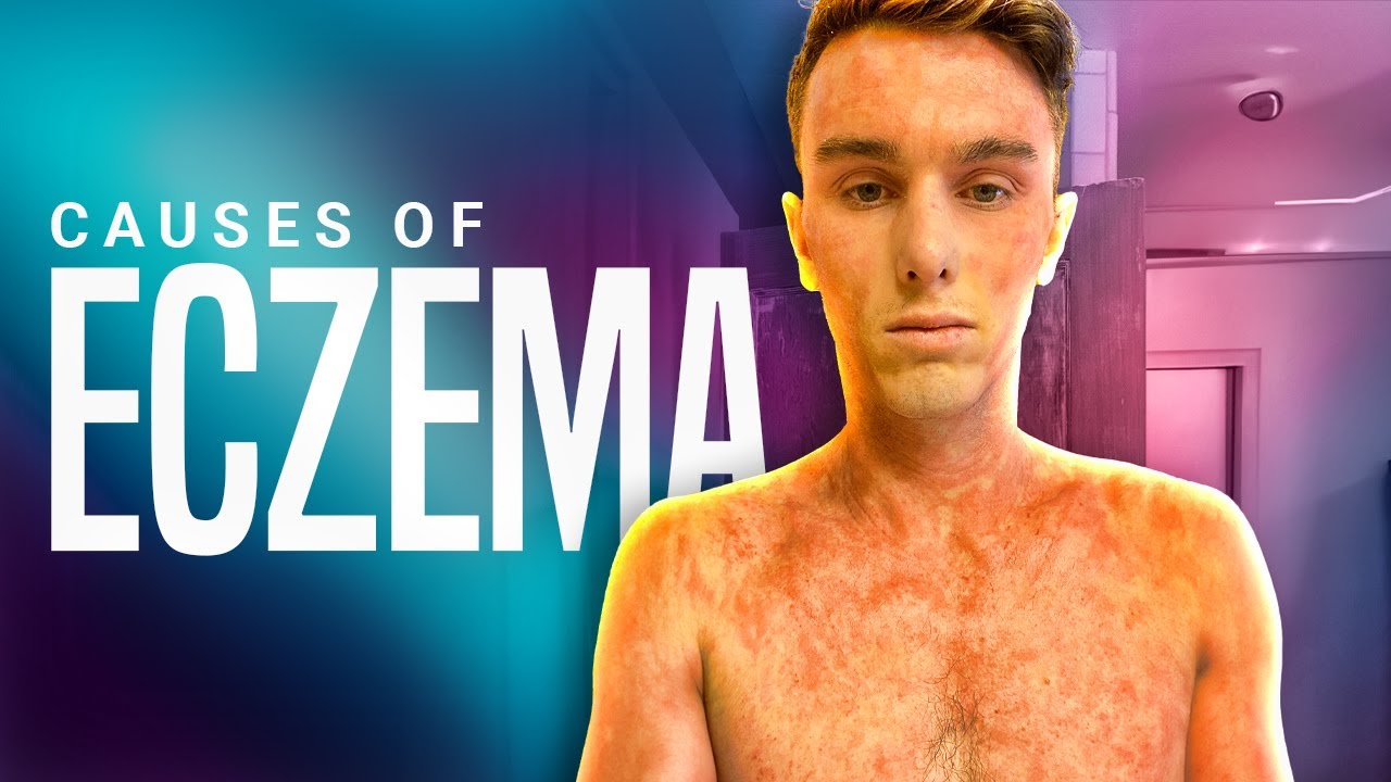 Healing Eczema Naturally 12 Causes of Eczema YouTube