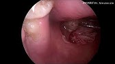 扁桃腺摘除手術後一週 喉嚨正常的白色傷口post Tonsillectomy Wound After 1 Week Youtube