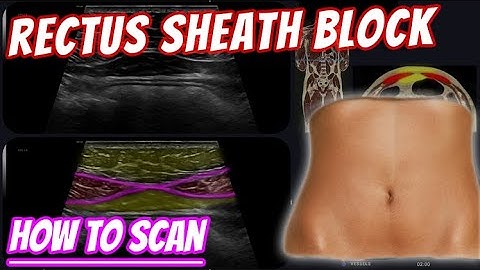 Rectus sheath block - How to scan