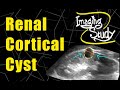 Renal Cortical Cyst - Bosniak Grade-II || Ultrasound || Case 89