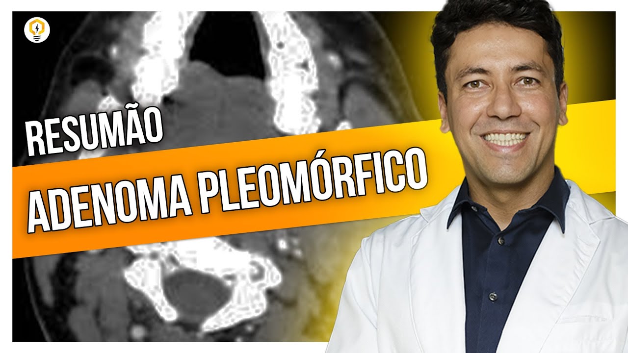 Resumo sobre ADENOMA PLEOMÓRFICO (com Dr. Rodrigo Flamini)