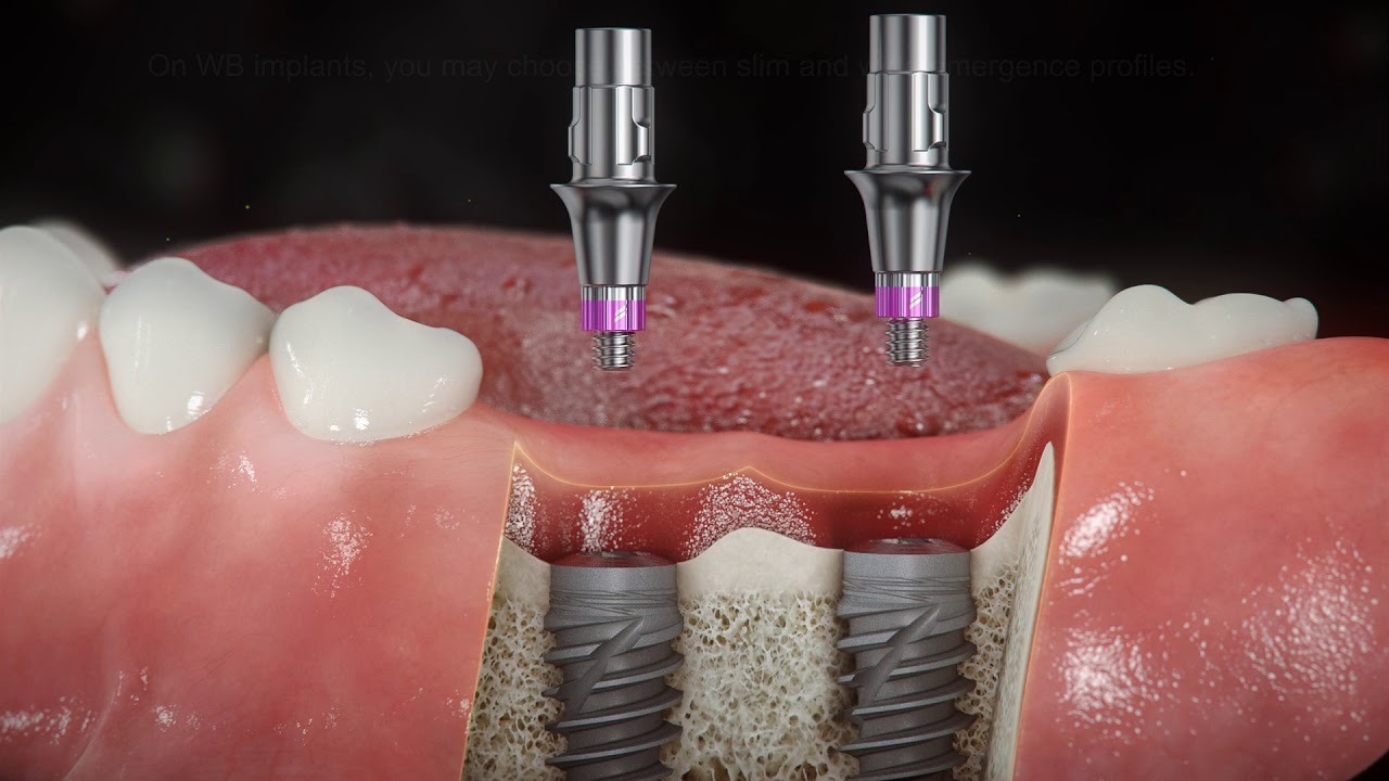 Straumann BLX emergence profile