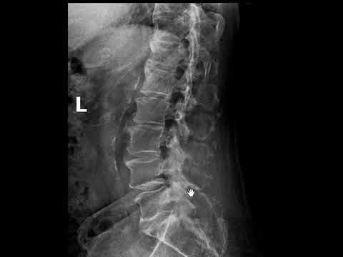 Video: Ar apărea o tumoare a coloanei vertebrale la radiografie?