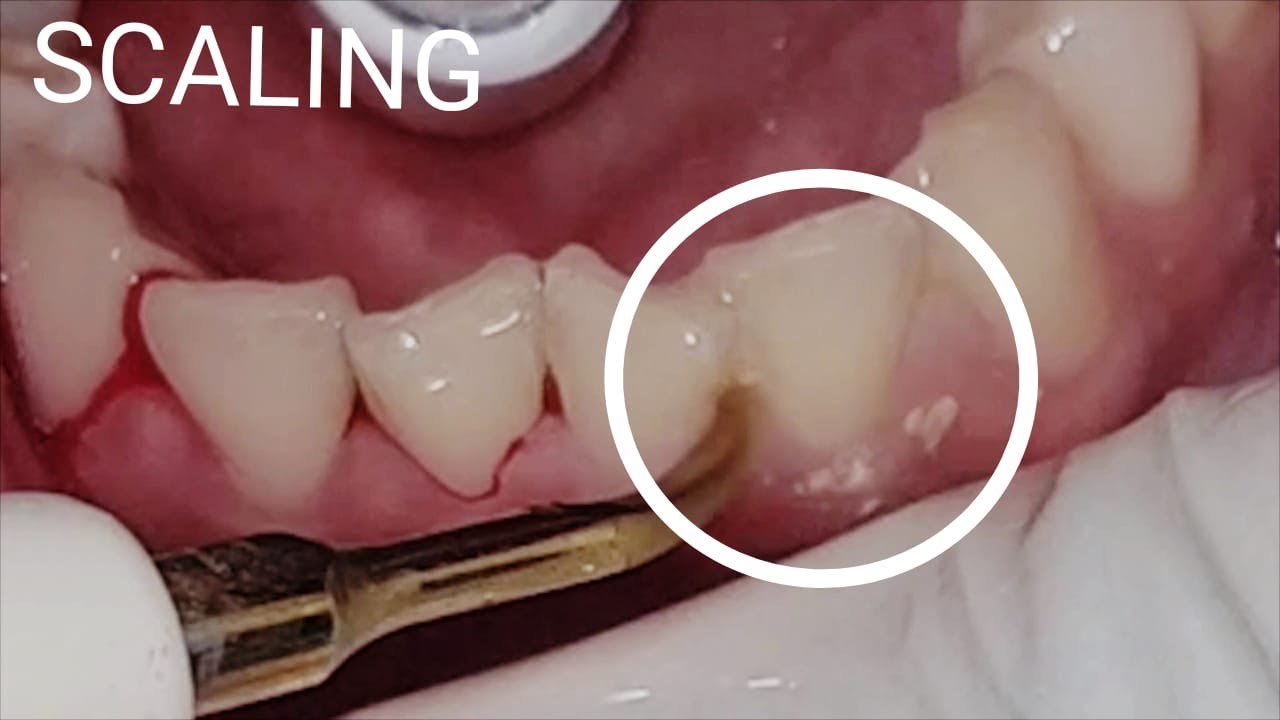 Dental Scaling YouTube