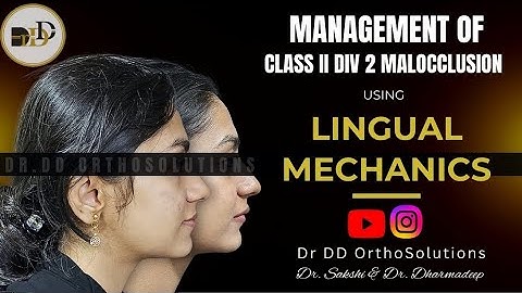 Management of Class II Division 2 Malocclusion using Lingual Orthodontics.