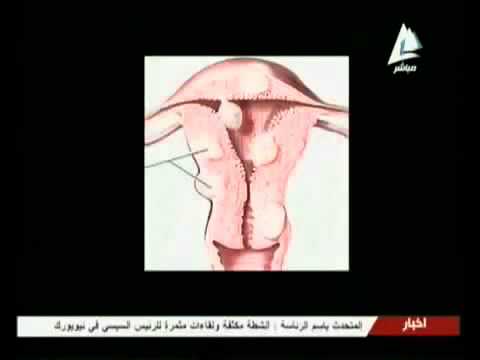 دكتور ياسر ناجى الأشعة التداخلية وعلاج نزيف ما بعد الولادة