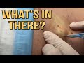 Gambit's Abscess with Follow Up - Top Videos #36