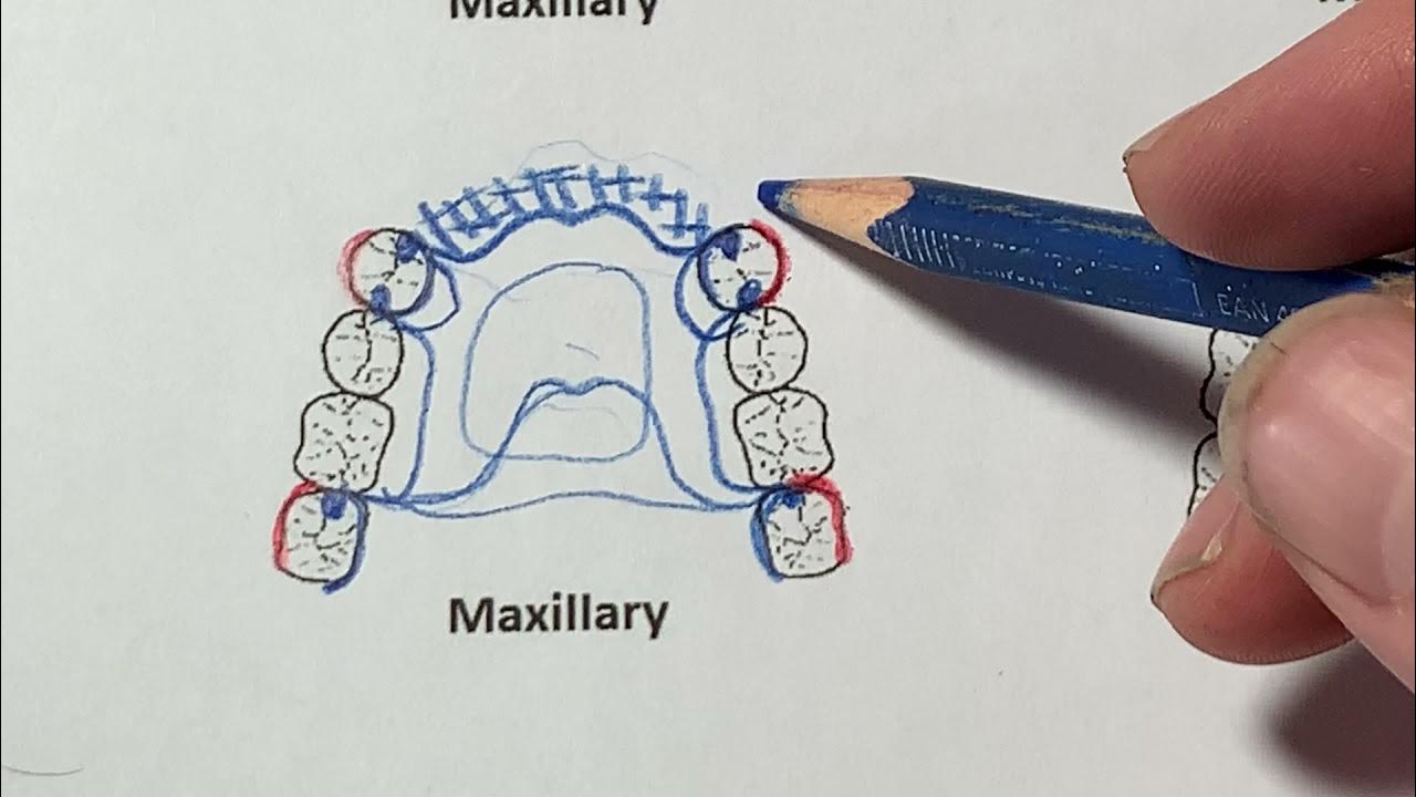 Cast Partial Denture Design Kennedy Class IV YouTube
