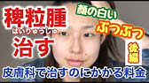 前編 稗粒腫 はいりゅうしゅ の治し方 あっと言う間に解決 顔にある白いぶつぶつに悩まされていませんか 皮膚科 Youtube