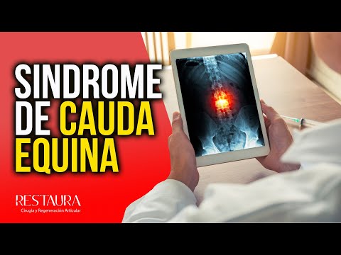 Vídeo: Síndrome De Cauda Equina: Síntomas, Tratamiento Y Más