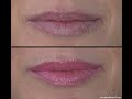 Quick Fix for Lip Wrinkles