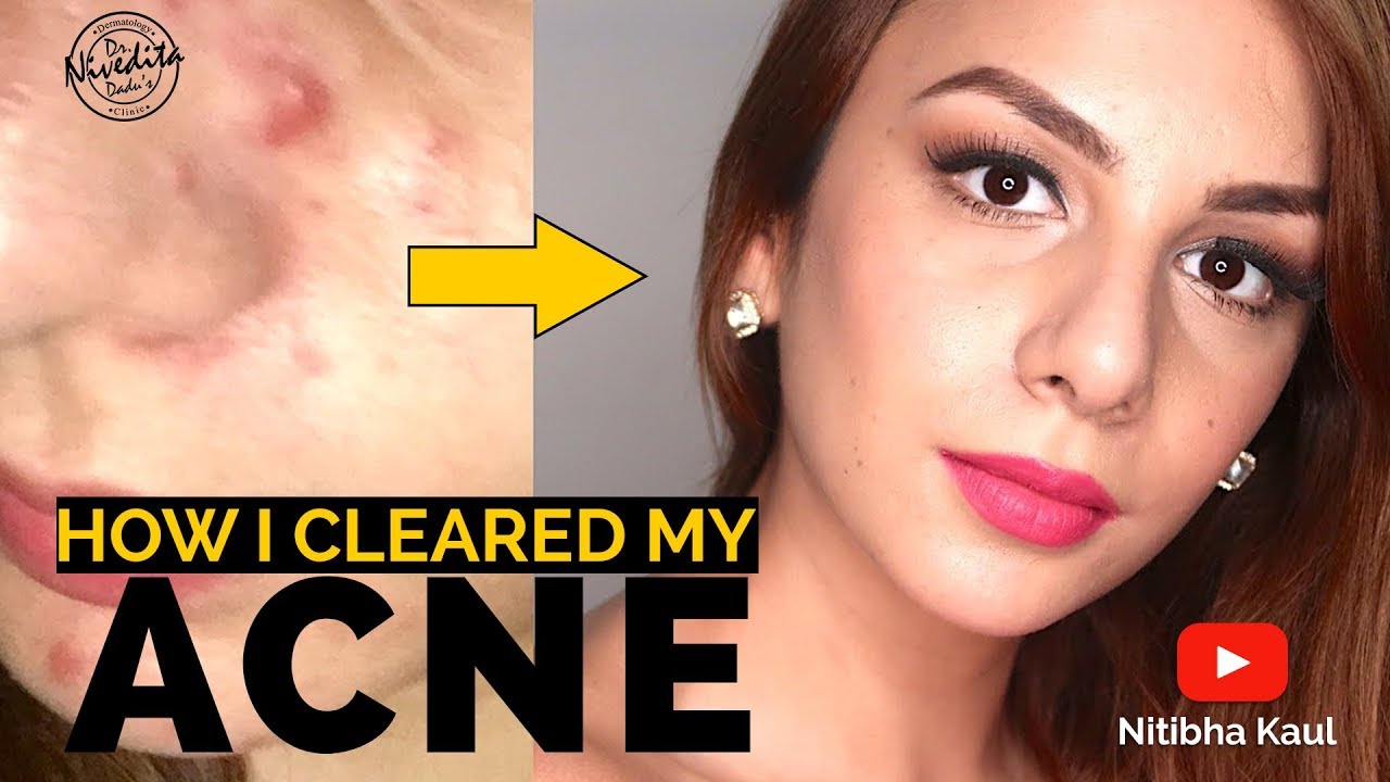 How I got rid of Acne Completely and Transformed my Skin? My Acne Story ...