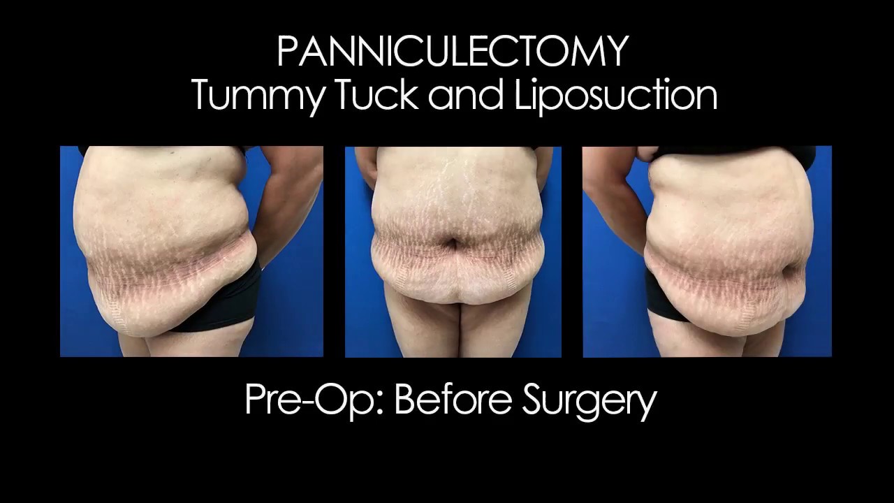 tummytuck