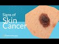 Skin Cancer Screening | Symptoms, Types & Warning Signs