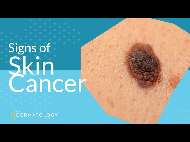 Skin Cancer | Symptoms, Types & Warning Signs YouTube