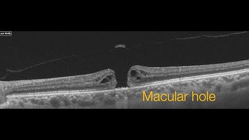 Macular hole surgery second eye | Inverted ILM flap technique | Vitrectomía agujero macular
