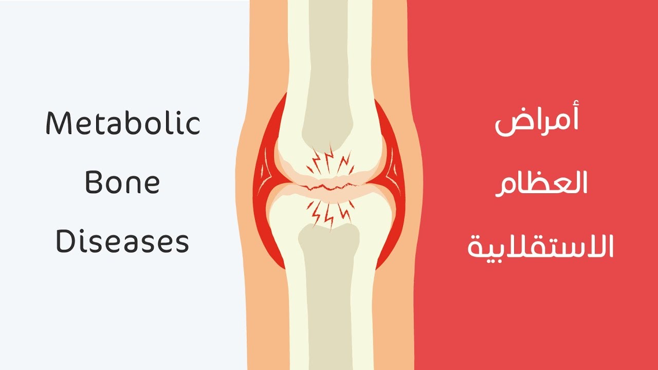 أمراض العظام الاستقلابية| Metabolic bone diseases